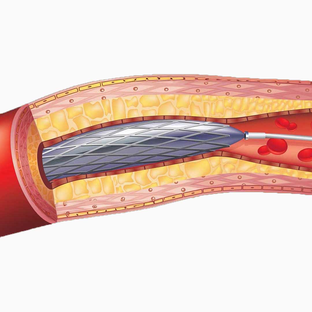 Angioplastía Stent - Remodelación de arteria