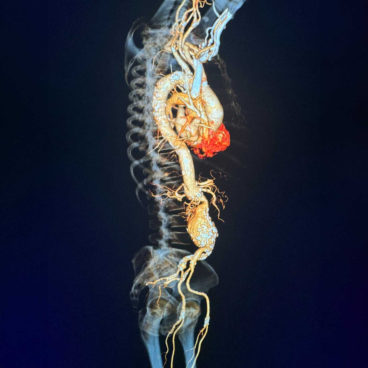 Colocación de endoprótesis en aneurisma en la aorta abdominal infrarrenal